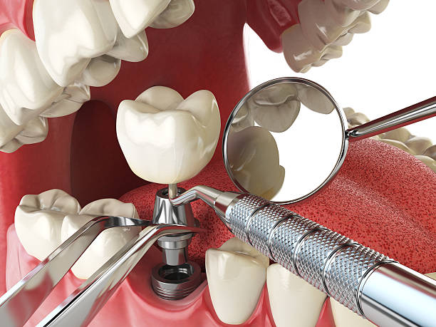 Best Emergency Dental Care for Broken or Chipped Teeth in Cowpens, SC